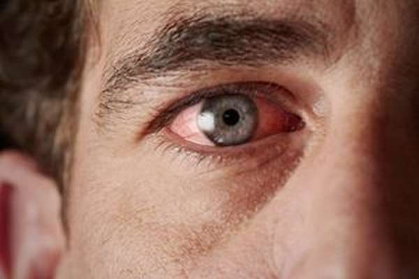 Способы лечения воспаления глаз от сварки